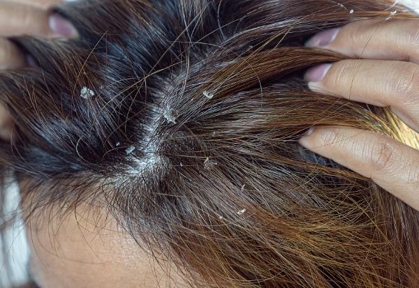 menghilangkan ketombe